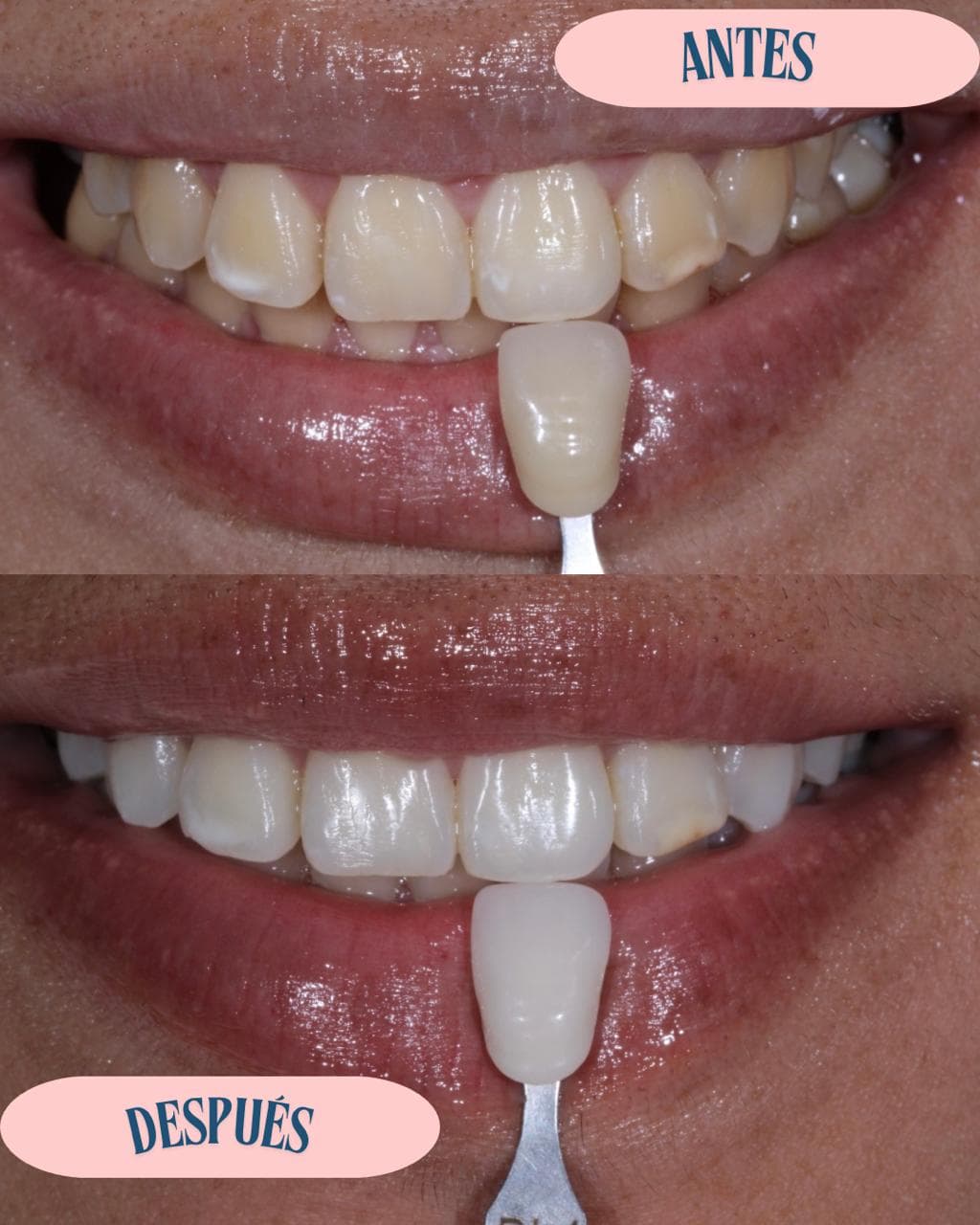Blanqueamiento dental