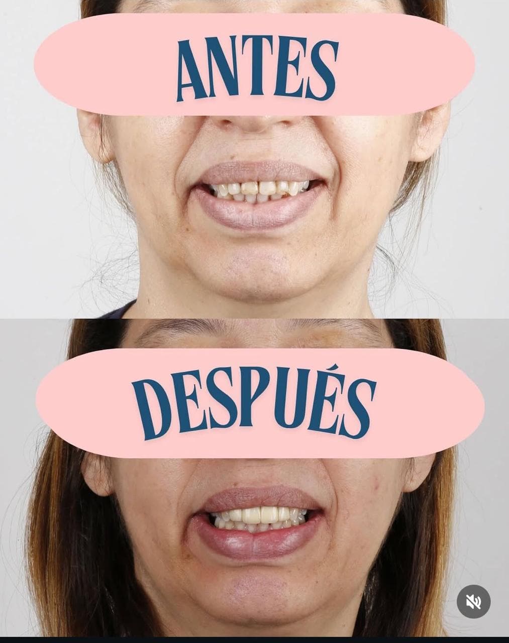 Carillas de Resina Compuesta