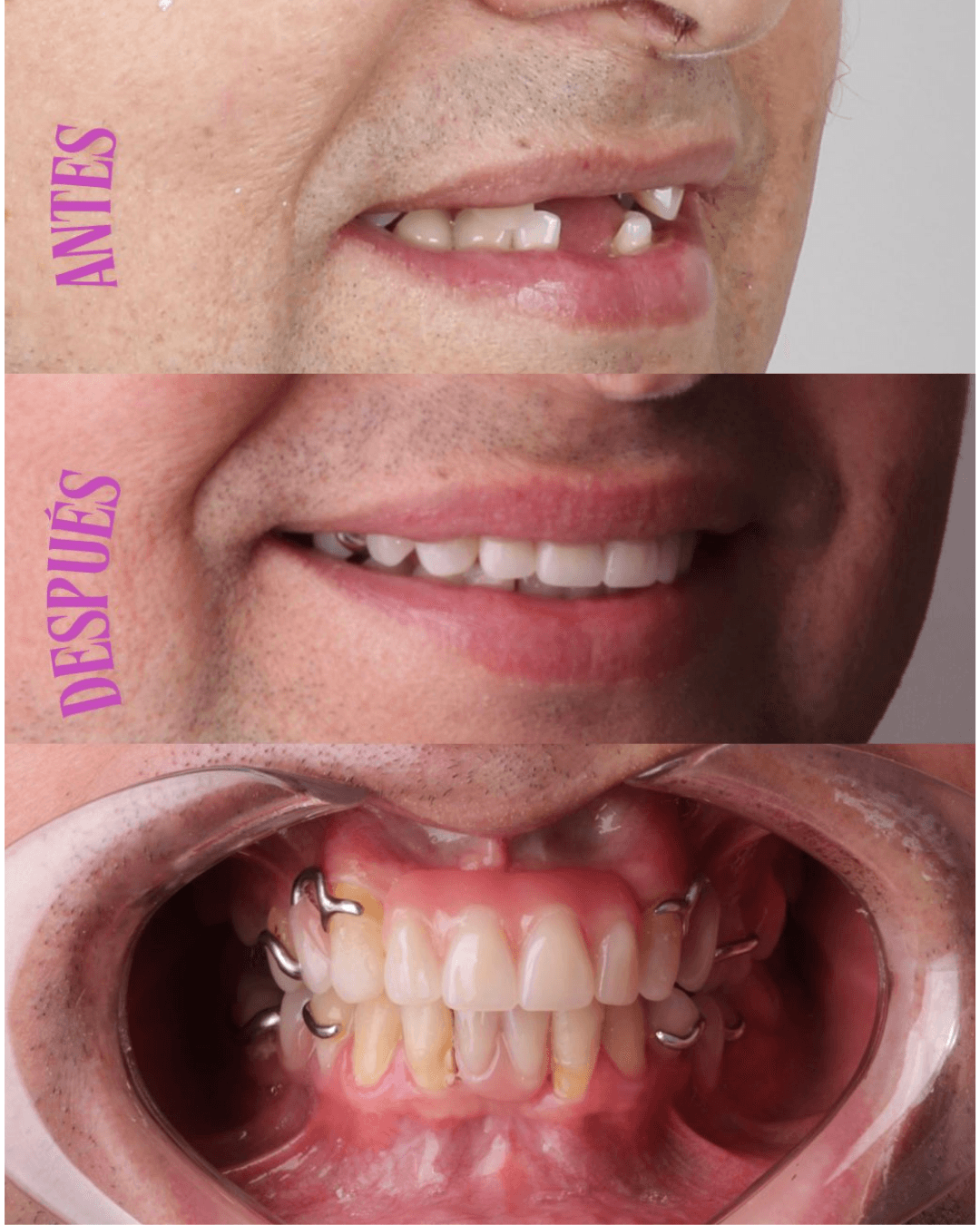 Prótesis parcial removible